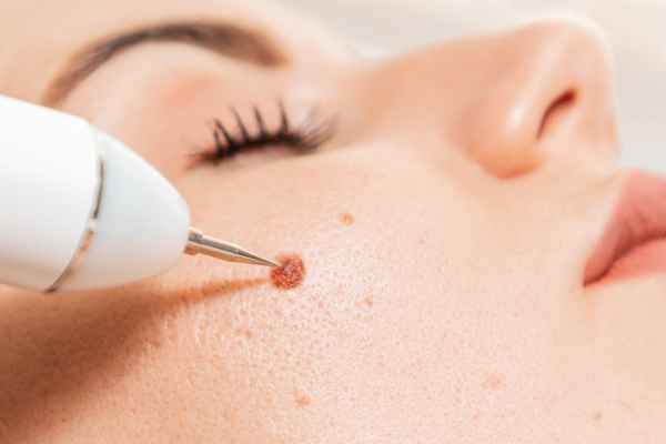 CryoPen: 5 Skin Concerns It May Be Used to Treat 3 What actually happens during a CryoPen treatment Wednesbury?