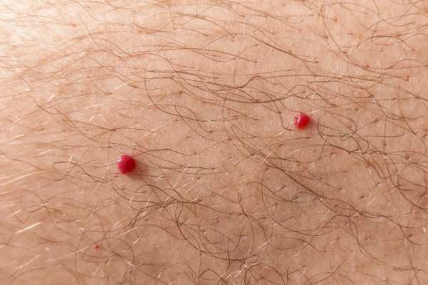 CryoPen: 5 Skin Concerns It May Be Used to Treat 2 cherry angioma removal Wednesbury
