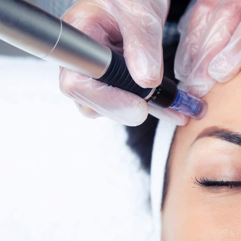 Morpheus8 treatment Wednesbury from Lipo Sculpt - Book in today!