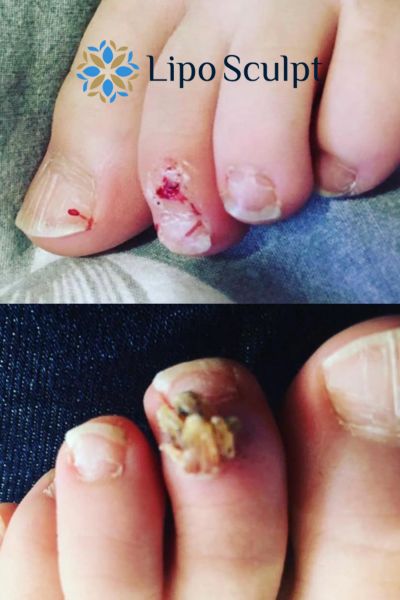 Wart removal customer results from Lipo Sculpt Wednesbury